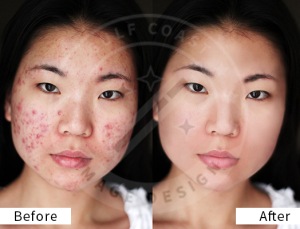 Acne Removal